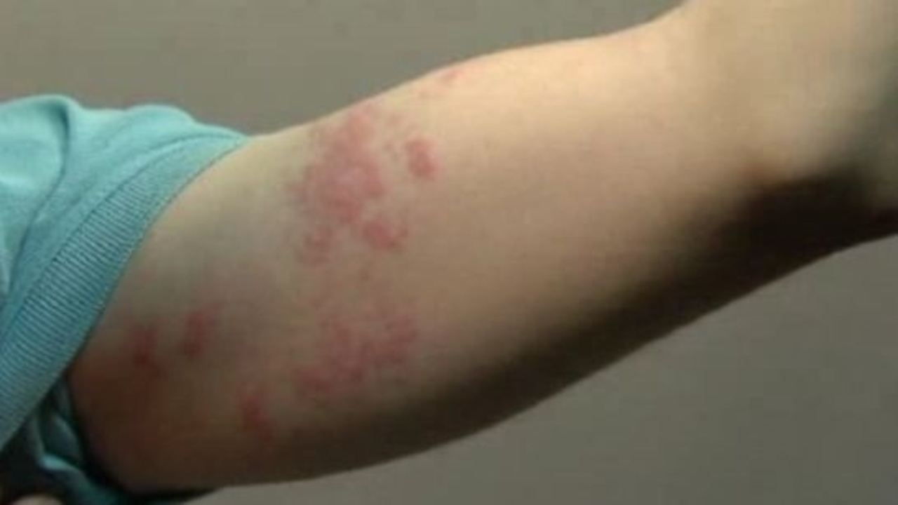 Poison ivy threat in winter, too